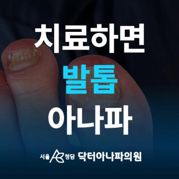 치료하면 발톱 아나파