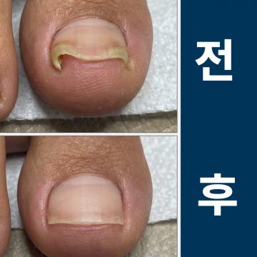 걸을 때마다 찌릿한 발가락 통증