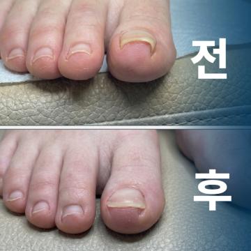 내성발톱 참지말고 해결하세요